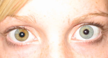 Pupula duplex iyi belgelenmemiş (veya gerçek) olmayabilir, ancak burada insanların sahip olduğu birkaç durum var. Örneğin, irislerin ayrı renklenmesine neden olan heterochromia iridum.