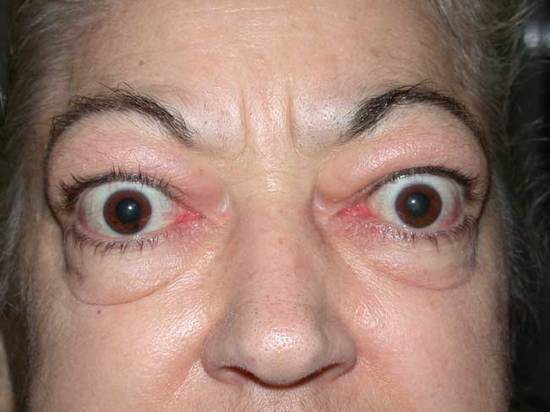 Proptoz, kısa köpek ırklarında (puglar gibi) yaygın olan bir durumdur, ancak insanlarda da ortaya çıkabilir. Gözlerin fazla öne kaymasına neden olur. 