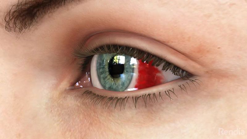 Göz kanaması nedir? Göz Kanaması Belirtileri Teşhis ve Tedavisi
